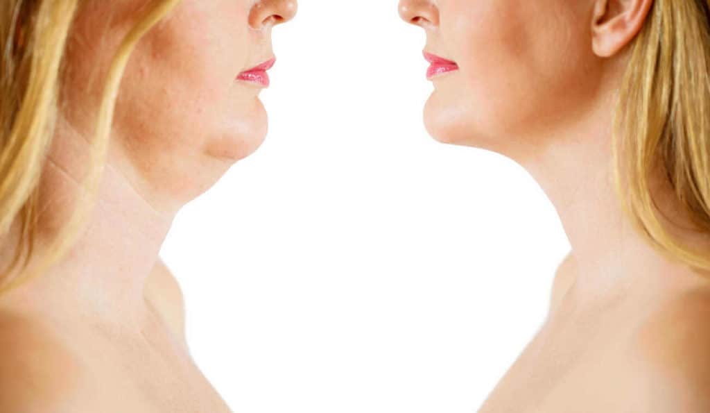 Double Chin treatment Redbourn before and after results