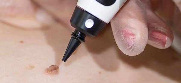 After Skin Tag Removal Redbourn