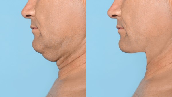Which Non-Surgical Treatments Work Best for Jowls and Loose Skin Redbourn?