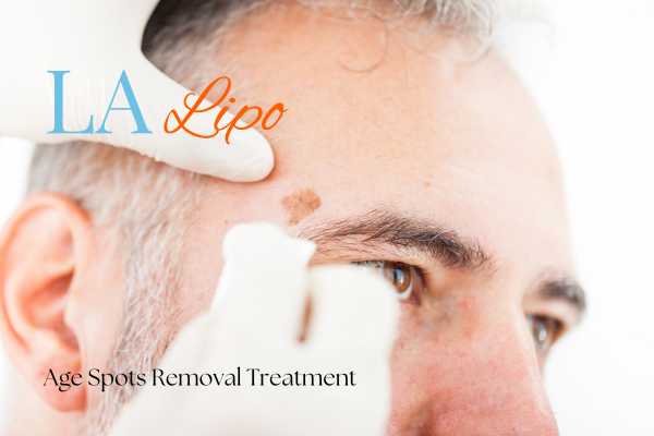 What Are the Most Effective Treatments for Age Spots Redbourn?