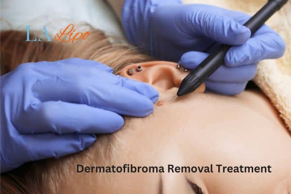 Dermatofibroma Removal Treatment Redbourn