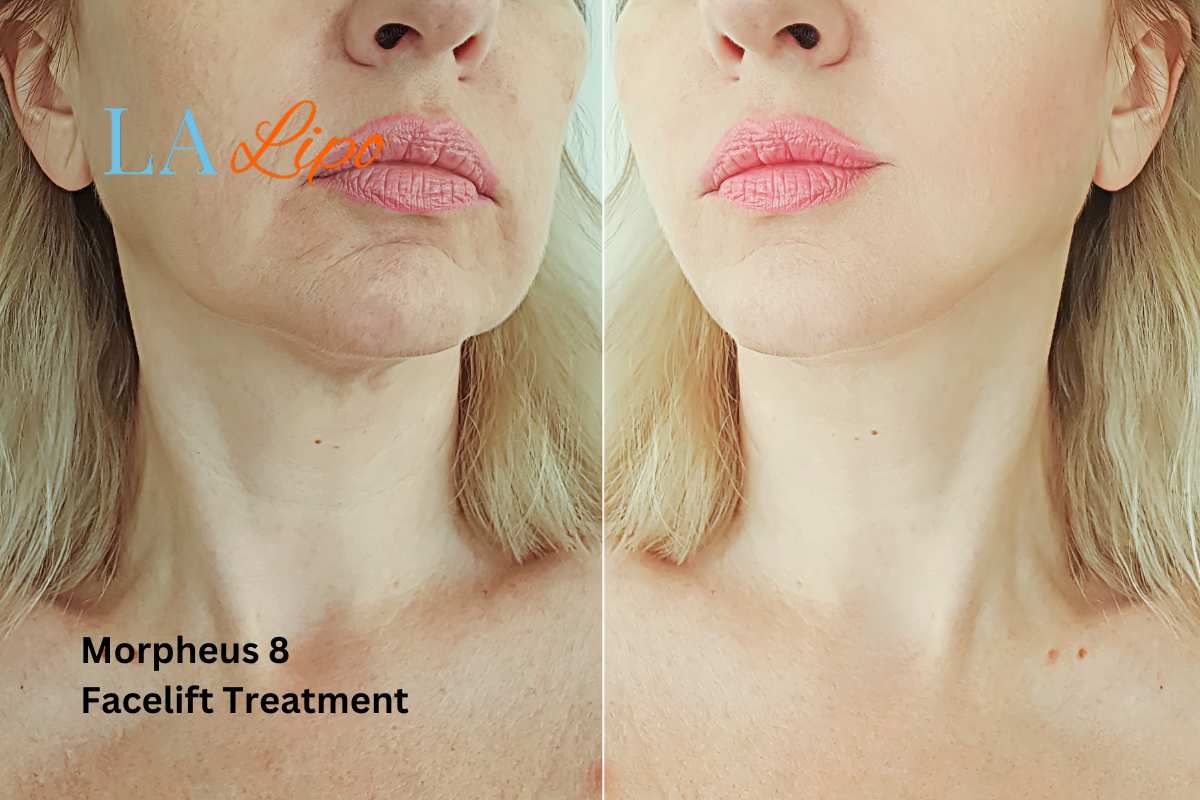 Turn back time with Morpheus8 Treatment Redbourn