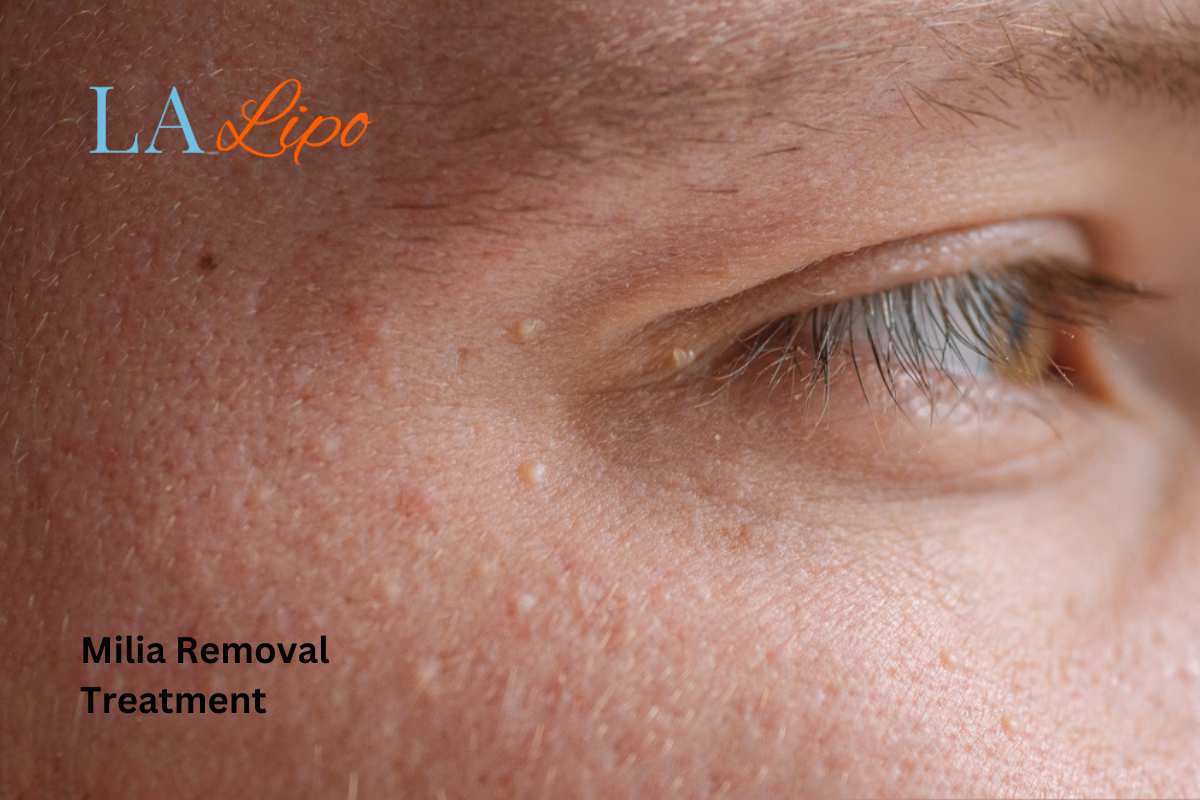 Cryopen Milia Removal: Is It the Easiest and Safest Option Redbourn?