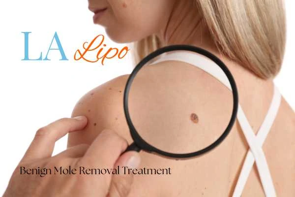 Woman having her inspection of blemish before mole removal Redbourn