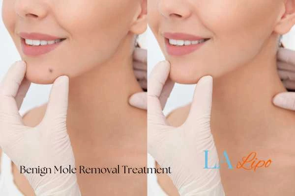 Before and after mole removal Redbourn treatment