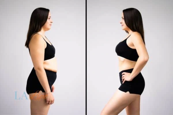 image of woman before and after results of LA-EMS Body Sculpting Redbourn to help treat Diastasis recti