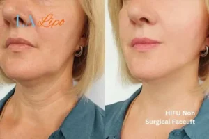 hi-fu for wrinkles Redbourn before and after results