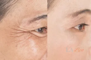 Before and after results of woman - HI-fu wrinkles reduction treatment Redbourn