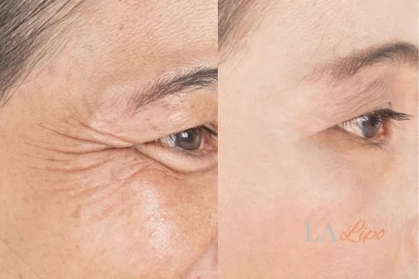 Before and after results of woman - HI-fu wrinkles reduction treatment Redbourn