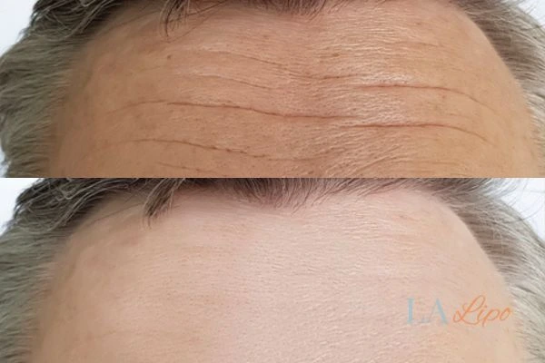 results of HIFU Redbourn on mans forehead to help reduce lines and wrinkles
