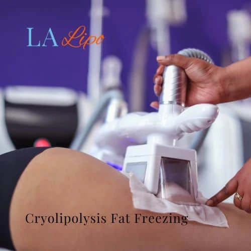 fat freezing - Cryolipolysis Redbourn