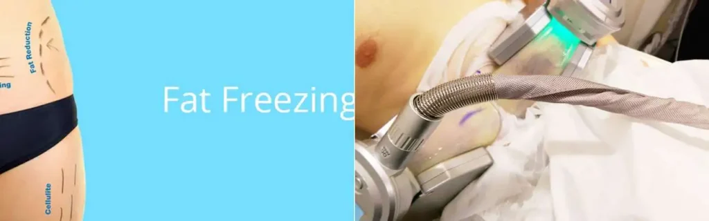 multi areas of a persons body having coolsculpting Redbourn treatment