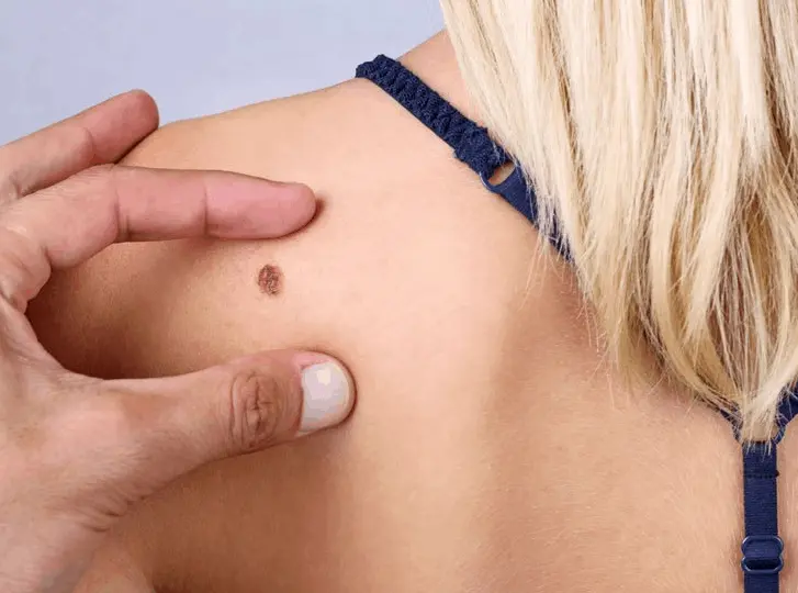woman having mole removal Redbourn consultation before treatment.