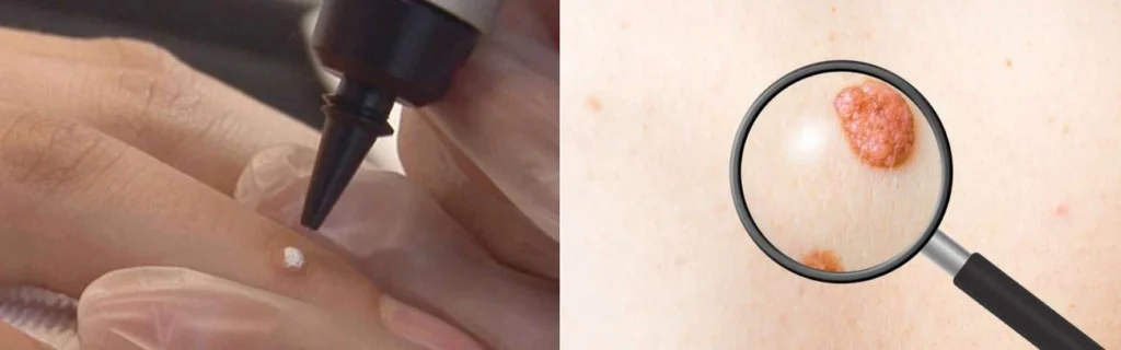 Person getting moles removed with cryopen Redbourn