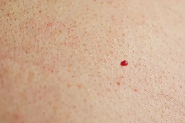 close up of a cherry angioma Redbourn