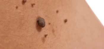 image of a skin tag Redbourn