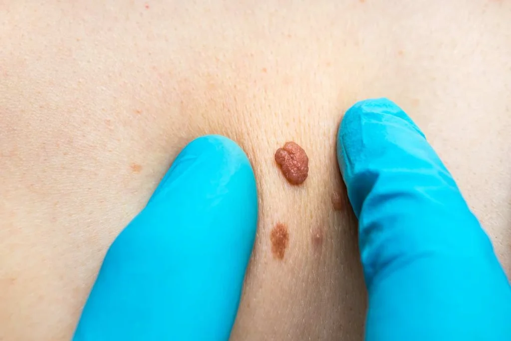 Consultant examining a skin tag Redbourn