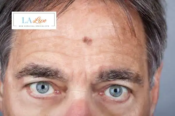 Solar Lentigo Removal Redbourn image of man with mark on his forehead