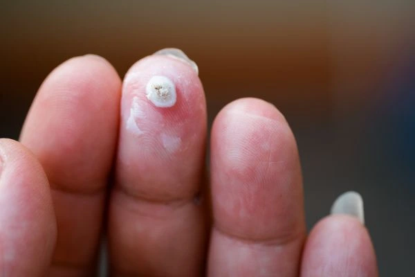 wart on person finger - cryotherapy to treat from LA LIPO Redbourn