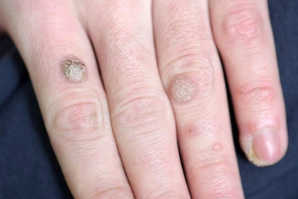 photo of warts on person hand - see wart removal Redbourn from LA LIPO