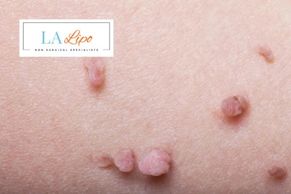 Does cryopen skin tag removal Redbourn hurt? Find out now call our team today!