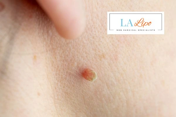 Book skin tag removal Redbourn today speak to our team now!