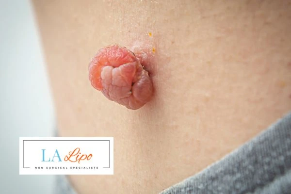 Interested in skin tag removal Redbourn? Concerned about the pain? Find out more today!