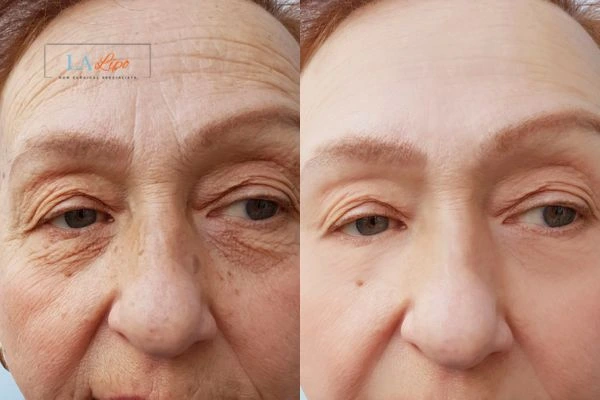 The powerful benefits of Morpheus8 Treatment Redbourn - Call Our team today!
