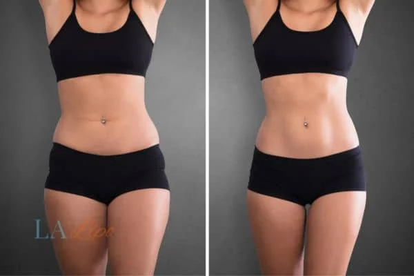 before and after results of non-surgical treatment to help a woman's body image and mental health Redbourn