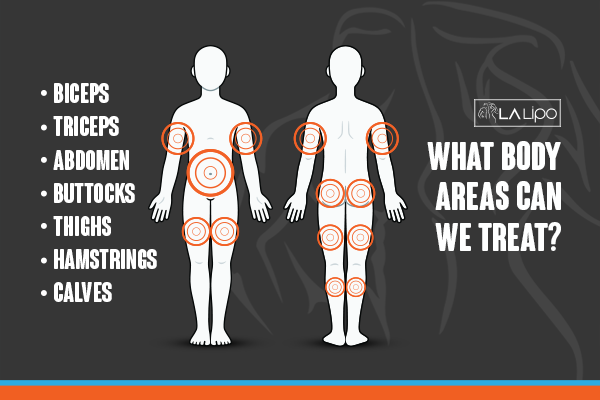 Diagram to show areas you can have LA-EMS Body Sculpting Treatment Redbourn