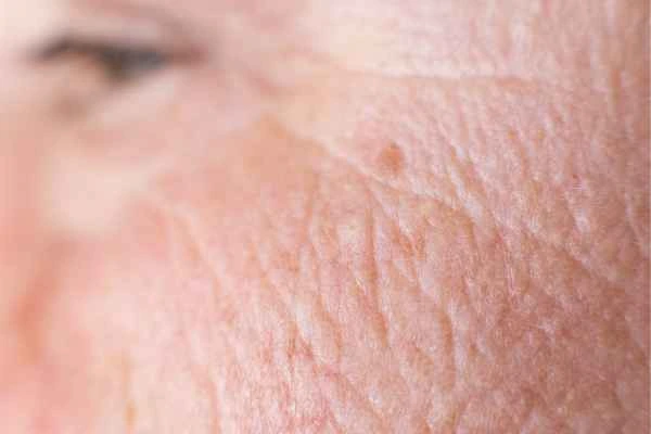 close up picture of a woman's face showing an age spot Redbourn