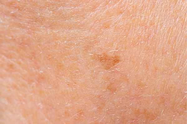 close up picture of age spots Redbourn