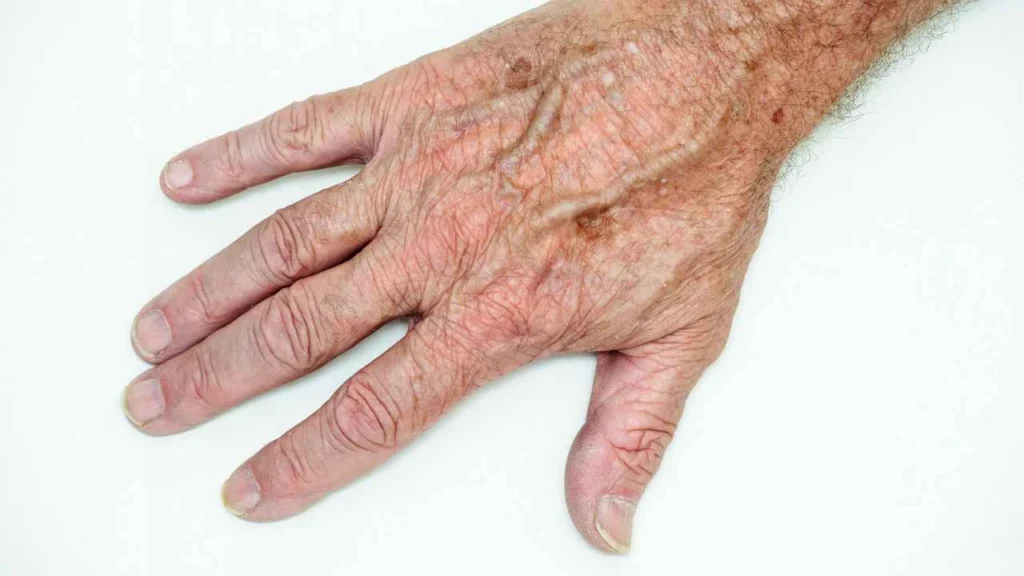 Male hand showing age spot Redbourn