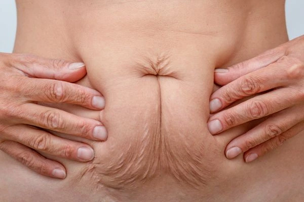 Image of a woman's stomach with loose skin - example of skin tightening Redbourn options