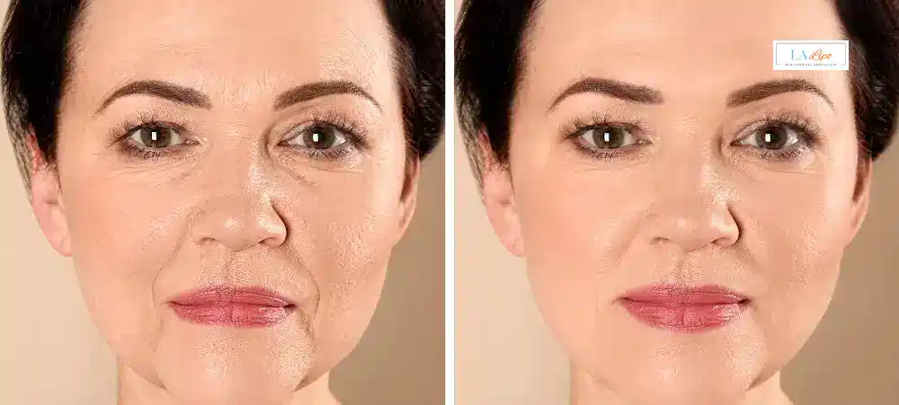 How Long Does It Take to See Results and How Long Do They Last Redbourn?
